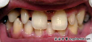安安牙醫 Angel Dentist 門牙整形 快速矯正 全瓷牙冠 全瓷貼面 奈米樹脂貼面 牙齒美白 