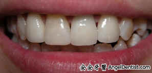 安安牙醫 Angel Dentist 門牙整形 快速矯正 全瓷牙冠 全瓷貼面 奈米樹脂貼面 牙齒美白 