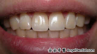 安安牙醫 Angel Dentist 門牙整形 快速矯正 全瓷牙冠 全瓷貼面 牙齒美白 